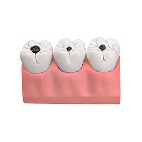 Dental Caries Model