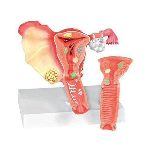 Pathological Model of Female Reproductive System