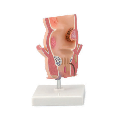 Pathological Model Of The Rectum